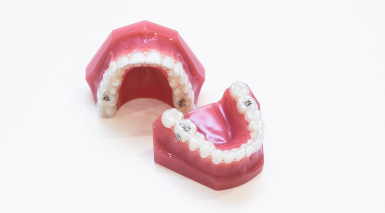 マウスピース矯正