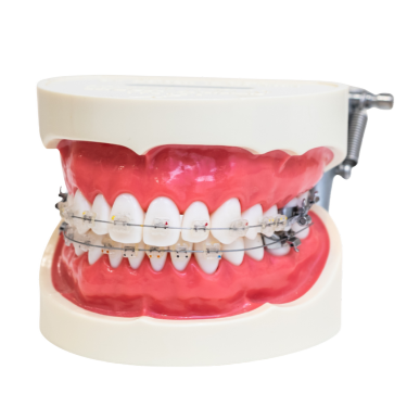 マルチブラケット（ワイヤー矯正）