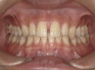 軽度すきっ歯症例画像