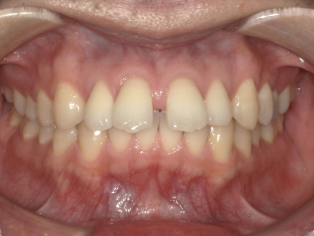 中等度すきっ歯症例画像