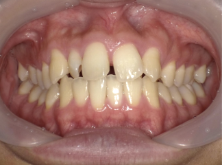重度すきっ歯症例画像