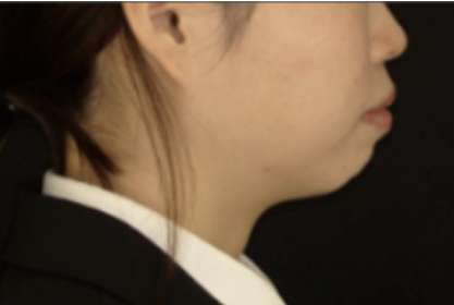 口ゴボ中等度症例画像