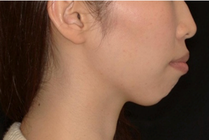 口ゴボ重度症例画像