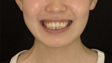 ガミースマイル軽度症例画像