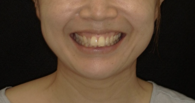 ガミースマイル中等度症例画像