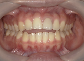 症例画像挿入予定