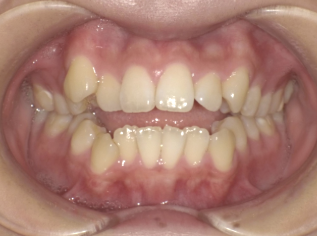 開咬の重度症例