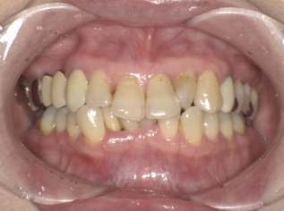 過蓋咬合軽度症例画像