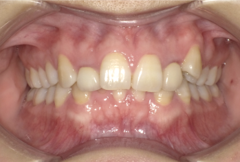 過蓋咬合中等度症例画像