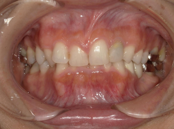 過蓋咬合重度症例画像