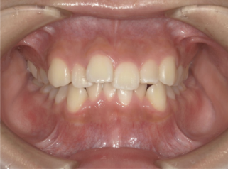 軽度叢生・八重歯症例画像