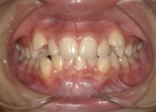 中等度叢生・八重歯症例画像