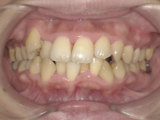 重度叢生・八重歯症例画像