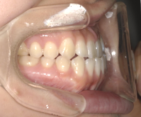 軽度受け口症例画像