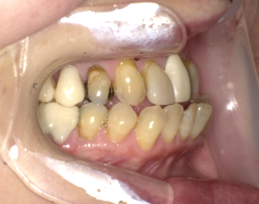 重度受け口症例画像