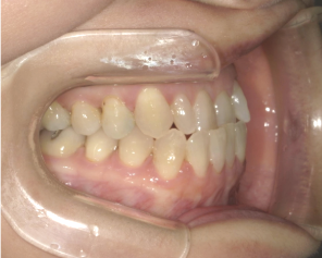 中等度受け口症例画像