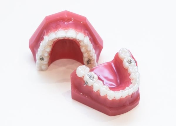 インビザライン（マウスピース矯正）