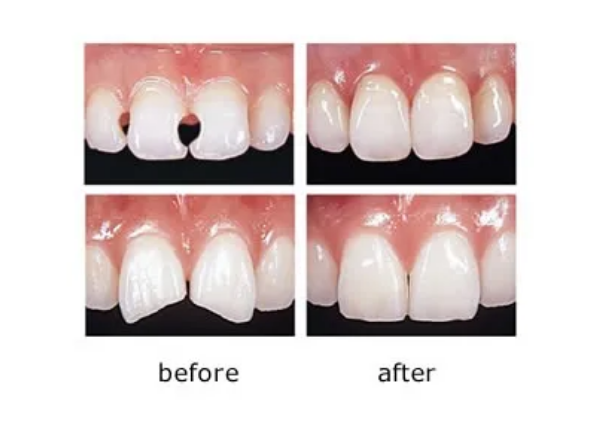 ダイレクトボンディング