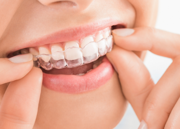 マウスピース矯正（インビザライン）で行う口ゴボ矯正