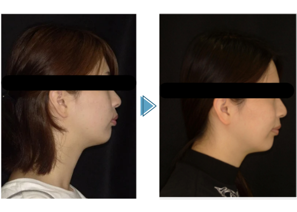 横から見た症例