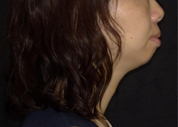 口が閉じにくくなった