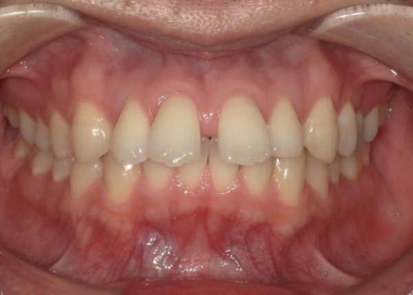 歯に隙間ができた