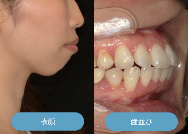 出っ歯になってしまった