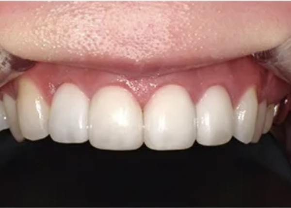 セラミッククラウンやラミネートべニア