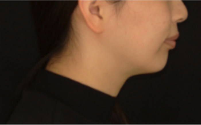 矯正治療・After