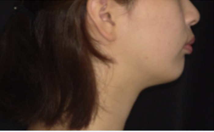 矯正治療・Before