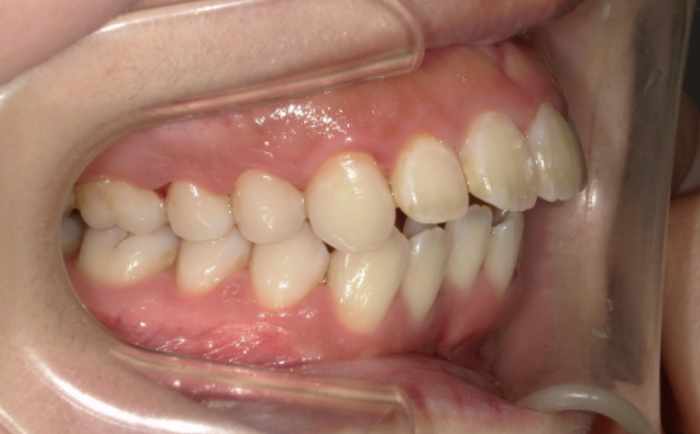 出っ歯を治したい