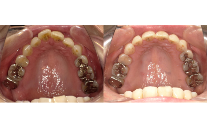 補綴物があるけど、インビザライン治療をしたい