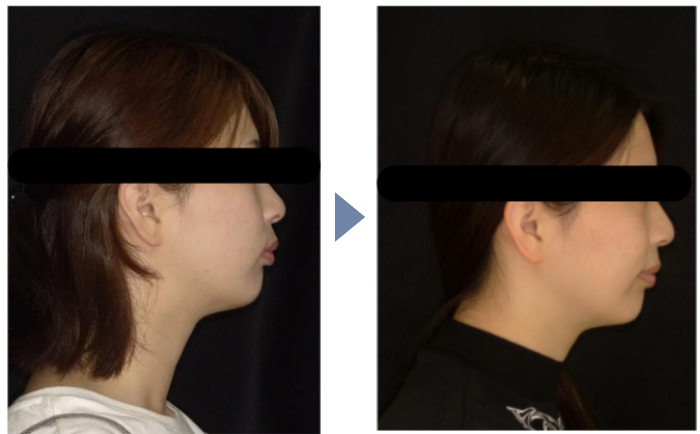 Eラインを整えたい