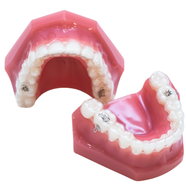 インビザライン(スピード矯正)