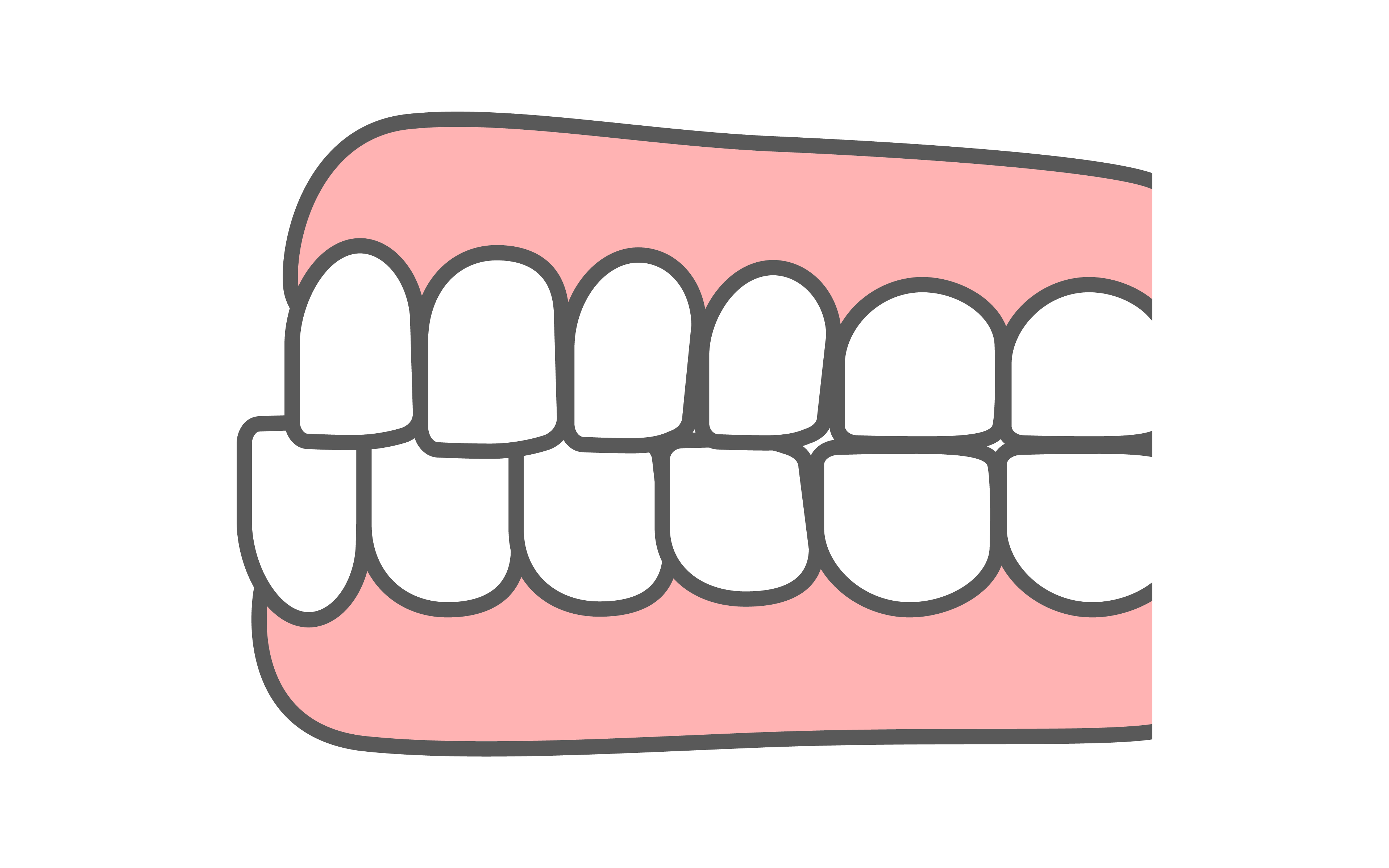 受け口（下顎前突）