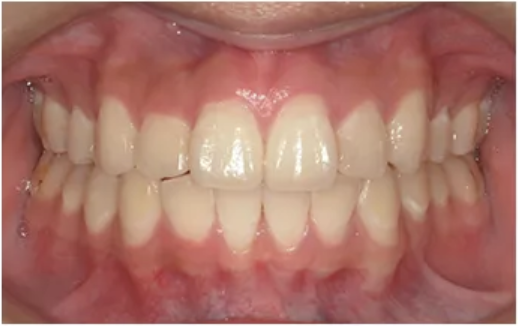 オルソパルス併用・After