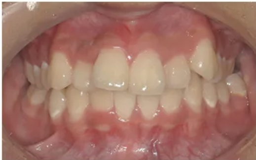 オルソパルス併用・Before