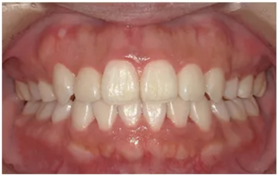 目立たない矯正・After