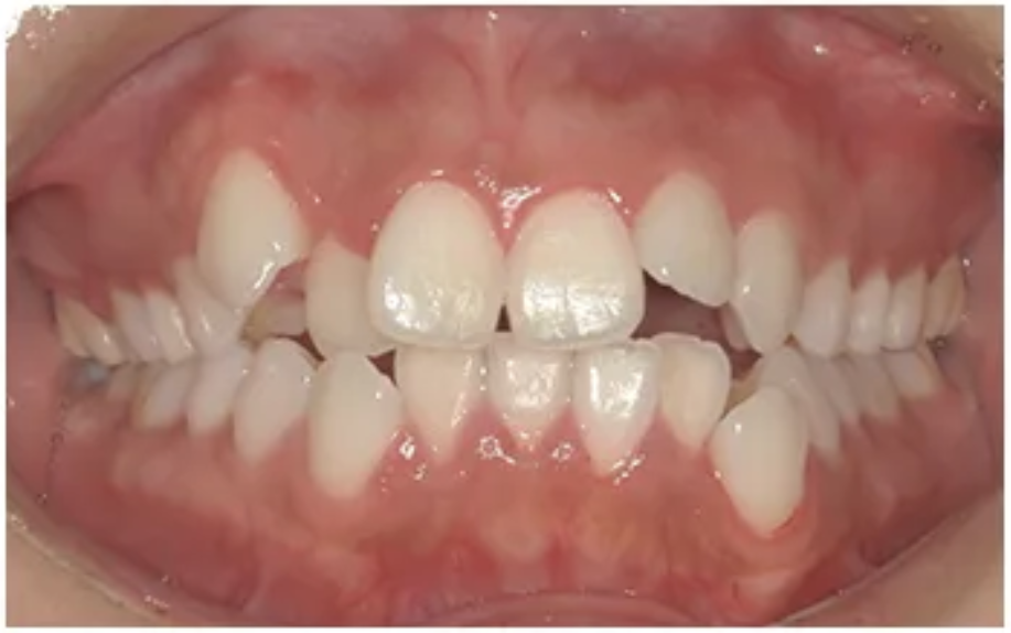 目立たない矯正・Before