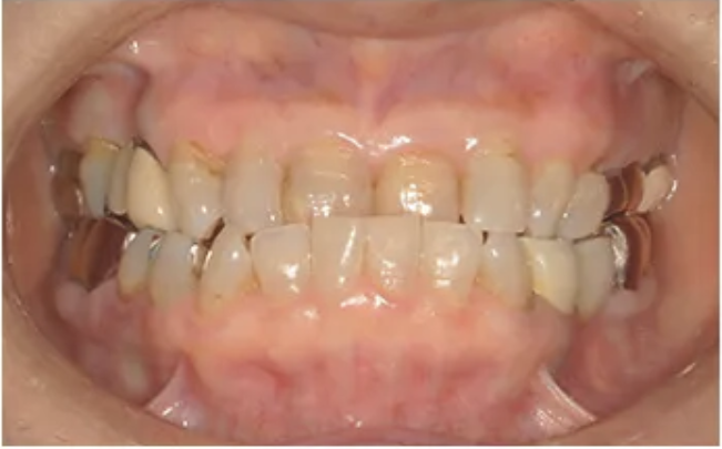 矯正治療・Before