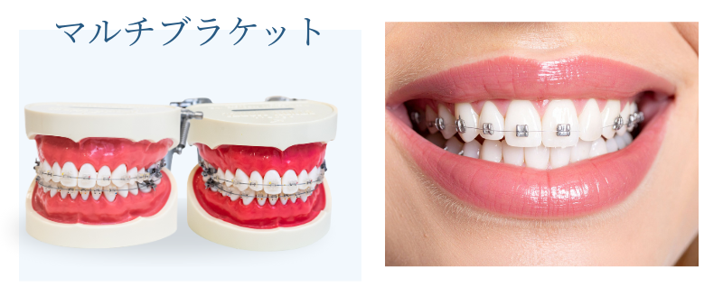 ワイヤー矯正（イメージ）