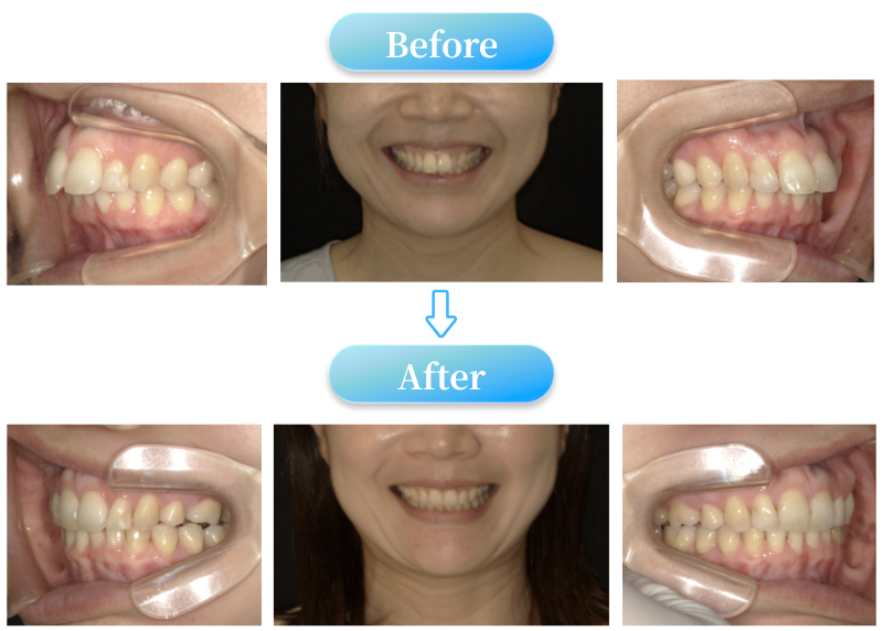 ガミースマイル症例