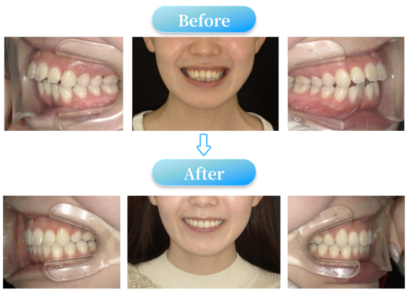 ガミースマイル症例