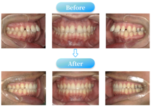 すきっ歯症例BeforeAfter画像