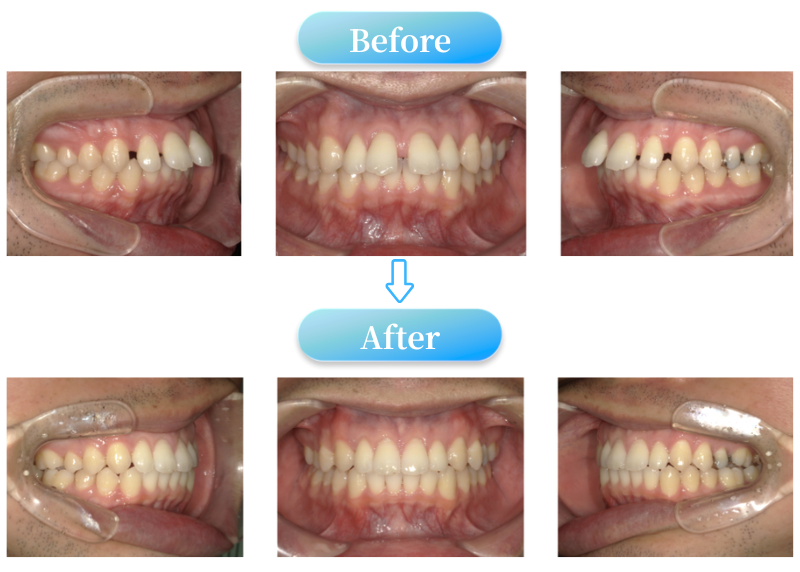すきっ歯症例BeforeAfter画像