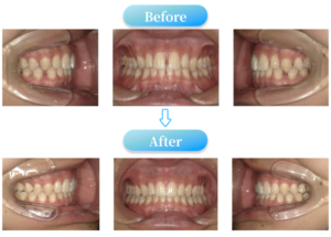 すきっ歯症例BeforeAfter画像