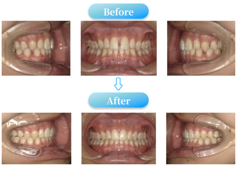 すきっ歯症例BeforeAfter画像