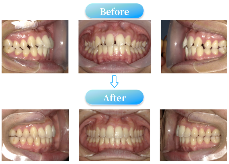 すきっ歯症例BeforeAfter画像
