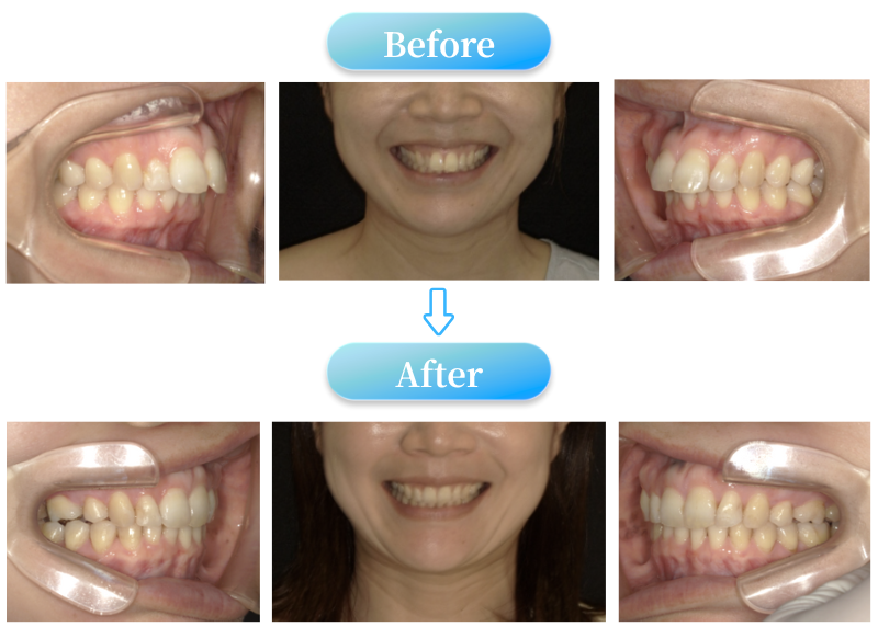 ガミースマイルの症例BeforeAfter画像