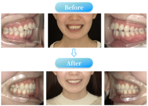 ガミースマイルの症例BeforeAfter画像